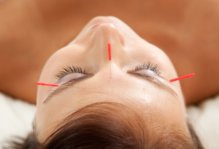 Acupuncture: The Non-Drowsy Allergy Treatment