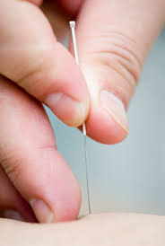 Inserting a hair thin needle into the low back to treat pain